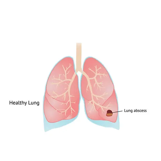 Lung Abscess - Symptoms, Types, Causes & Diagnosis